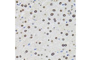 Immunohistochemistry of paraffin-embedded human liver damage using U2SURP antibody (ABIN6132839, ABIN6149759, ABIN6149760 and ABIN6220240) at dilution of 1:100 (40x lens). (SR140 antibody  (AA 705-1029))