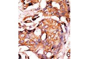 Formalin-fixed and paraffin-embedded human cancer tissue reacted with the primary antibody, which was peroxidase-conjugated to the secondary antibody, followed by AEC staining. (GUCY1A1 antibody  (N-Term))