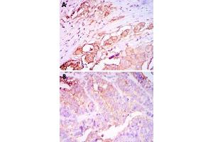 Immunohistochemical analysis of paraffin-embedded human rectum cancer tissue (A) and stomach cancer tissue (B) using CEACAM5 monoclonal antibody, clone 1C7  with DAB staining.