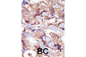 Immunohistochemistry (Formalin/PFA-fixed paraffin-embedded sections) of human breast carcinoma with MYLK3 polyclonal antibody , followed by peroxidase-conjugated secondary antibody and DAB staining. (MYLK3 antibody  (AA 40-69))