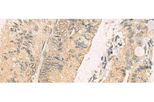 Immunohistochemistry of paraffin-embedded Human colorectal cancer tissue using THG1L Polyclonal Antibody at dilution of 1:70(x200) (THG1L antibody)