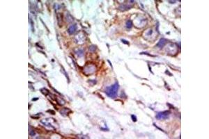IHC analysis of FFPE human breast carcinoma tissue stained with the ERK5 antibody (MAPK7 antibody  (AA 776-805))