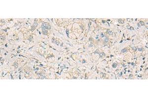 Immunohistochemistry of paraffin-embedded Human liver cancer tissue using WDR37 Polyclonal Antibody at dilution of 1:50(x200)