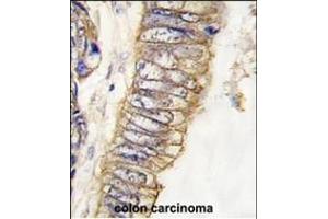 Formalin-fixed and paraffin-embedded human colon carcinoma tissue reacted with MET/HGFR Antibody (ABIN387741 and ABIN2837999) , which was peroxidase-conjugated to the secondary antibody, followed by DAB staining. (c-MET antibody  (Catalytic Domain))