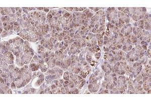 ABIN6273247 at 1/100 staining Human pancreas cancer tissue by IHC-P. (ARHGEF25/GEFT antibody  (Internal Region))