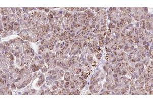 ABIN6273247 at 1/100 staining Human pancreas cancer tissue by IHC-P. (ARHGEF25/GEFT antibody  (Internal Region))