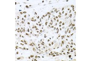 Immunohistochemistry of paraffin-embedded human lung cancer using BCCIP antibody. (BCCIP antibody)