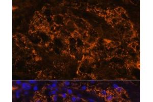 Immunofluorescence analysis of Human kidney cancer using SLC7A9 Polyclonal Antibody at dilution of 1:100. (SLC7A9 antibody)