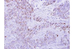 IHC-P Image I-309 antibody detects CCL1 protein at cytosol on human breast cancer by immunohistochemical analysis. (CCL1 antibody  (C-Term))