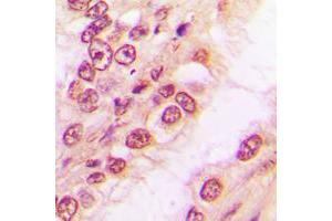 Immunohistochemical analysis of PAWR staining in human breast cancer formalin fixed paraffin embedded tissue section. (PAWR antibody  (C-Term))