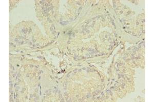 Immunohistochemistry of paraffin-embedded human prostate cancer using ABIN7151288 at dilution of 1:100 (TRIM9 antibody  (AA 1-550))