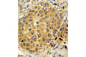 Formalin-fixed and paraffin-embedded human hepatocarcinoma reacted with PLG Antibody (C-term), which was peroxidase-conjugated to the secondary antibody, followed by DAB staining. (PLG antibody  (C-Term))