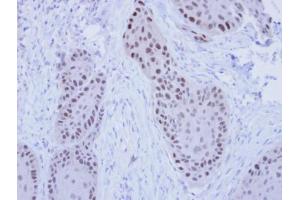 IHC-P Image Immunohistochemical analysis of paraffin-embedded MDAMB-468 Xenograft, using RFC4, antibody at 1:100 dilution. (RFC4 antibody)