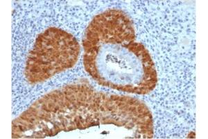 Formalin-fixed, paraffin-embedded human cervix stained with P16INK4a Recombinant Mouse Monoclonal Antibody (rCDKN2A/4845). (Recombinant CDKN2A antibody)