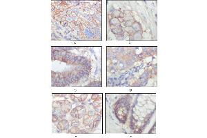 Immunohistochemical analysis of paraffin-embedded human lung squamous cell carcinoma (A), lung adenocarcinoma (B), colon carcinoma (C), breast carcinoma (D), normal sublingual gland (E), normal rectal (F), showing membrane localization with DAB staining using EphB3 mouse mAb. (EPH Receptor B3 antibody  (AA 39-212))