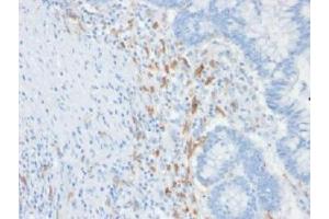 IHC testing of FFPE human colon carcinoma with DC-SIGN antibody (clone C209/1781). (DC-SIGN/CD209 antibody)