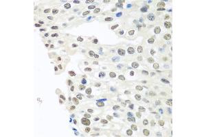 Immunohistochemistry of paraffin-embedded human prostate cancer using TARDBP antibody (ABIN6290985) at dilution of 1:100 (40x lens).