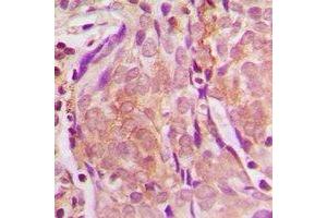 Immunohistochemical analysis of ZNF397 staining in human breast cancer formalin fixed paraffin embedded tissue section. (ZNF397 antibody  (N-Term))