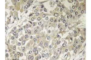 Immunohistochemistry analyzes of p70 S6K antibody in paraffin-embedded human breast carcinoma tissue. (RPS6KB1 antibody)