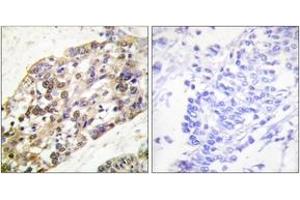 Immunohistochemistry analysis of paraffin-embedded human breast carcinoma tissue, using Histone H3 (Ab-28) Antibody. (Histone 3 antibody  (AA 13-62))