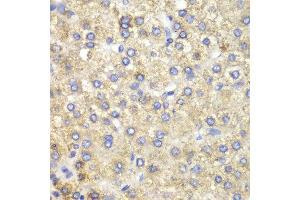 Immunohistochemistry of paraffin-embedded human liver cancer using HADH antibody at dilution of 1:100 (400x lens). (HADH antibody)
