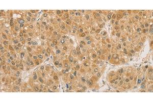 Immunohistochemistry of paraffin-embedded Human liver cancer using PGK2 Polyclonal Antibody at dilution of 1:50 (PGK2 antibody)