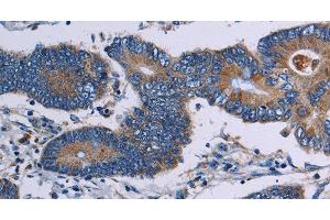Immunohistochemistry of paraffin-embedded Human colon cancer tissue using ITK Polyclonal Antibody at dilution 1:50 (ITK antibody)