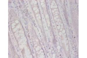 Immunohistochemistry of paraffin-embedded human colon cancer using ABIN7163507 at dilution of 1:50 (FUCA2 antibody  (AA 29-465))