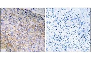 Immunohistochemistry analysis of paraffin-embedded human breast carcinoma tissue, using NOX3 Antibody. (NOX3 antibody  (AA 287-336))