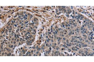 Immunohistochemistry of paraffin-embedded Human lung cancer tissue using PNPT1 Polyclonal Antibody at dilution 1:40 (PNPT1 antibody)