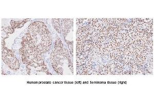 Paraffin embedded sections of human prostate canitrocelluloseer and seminoma tissue were initrocelluloseubated with anti-human TARDBP(1:50) for 2 hours at room temperature. (TARDBP antibody  (AA 1-260))