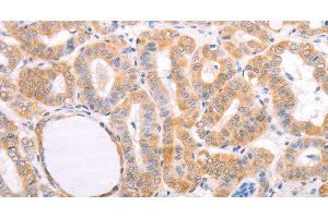 Immunohistochemistry of paraffin-embedded Human thyroid cancer tissue using pVHL Polyclonal Antibody at dilution 1:40 (VHL antibody)