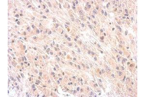 IHC-P Image Immunohistochemical analysis of paraffin-embedded U373 xenograft, using Factor H, antibody at 1:200 dilution. (Complement Factor H antibody)