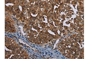 The image on the left is immunohistochemistry of paraffin-embedded Human ovarian cancer tissue using ABIN7191460(MIG7 Antibody) at dilution 1/35, on the right is treated with synthetic peptide. (TOX4 antibody)