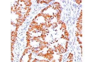 IHC staining of human colon carcinoma with p53 antibody (BP53-12). (p53 antibody  (N-Term))