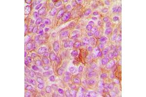 Immunohistochemical analysis of HER2 staining in human breast cancer formalin fixed paraffin embedded tissue section.