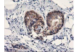 Immunohistochemical staining of paraffin-embedded Adenocarcinoma of Human breast tissue using anti-PDE4B mouse monoclonal antibody. (PDE4B antibody)