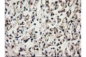 Immunohistochemical staining of paraffin-embedded Adenocarcinoma of Human colon tissue using anti-ACOT12 mouse monoclonal antibody. (ACOT12 antibody)