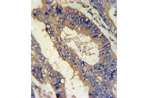 EREG Antibody (C-term) (ABIN650993 and ABIN2840027) IHC analysis in formalin fixed and paraffin embedded colon carcinoma followed by peroxidase conjugation of the secondary antibody and DAB staining. (Epiregulin antibody  (C-Term))