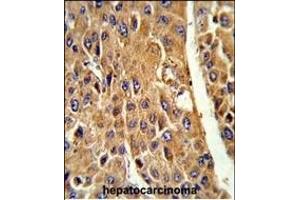 Formalin-fixed and paraffin-embedded human hepatocarcinoma reacted with CYP3A5 Antibody (Center) (ABIN652394 and ABIN2841919) , which was peroxidase-conjugated to the secondary antibody, followed by DAB staining. (CYP3A5 antibody  (AA 186-218))