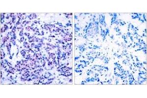 Immunohistochemistry analysis of paraffin-embedded human breast carcinoma, using JunD (Phospho-Ser255) Antibody. (JunD antibody  (pSer255))