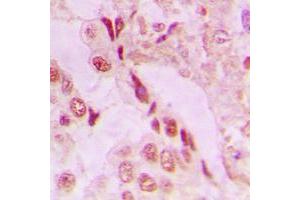 Immunohistochemical analysis of DJ-1 staining in human lung cancer formalin fixed paraffin embedded tissue section. (PARK7/DJ1 antibody  (Center))