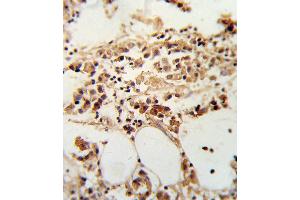 Formalin-fixed and paraffin-embedded human breast carcinoma reacted with TIMP3 Antibody , which was peroxidase-conjugated to the secondary antibody, followed by DAB staining. (TIMP3 antibody  (AA 113-139))