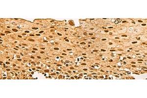 Immunohistochemistry of paraffin-embedded Human cervical cancer tissue using UBLCP1 Polyclonal Antibody at dilution of 1:80(x200) (UBLCP1 antibody)