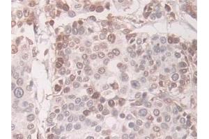 Detection of TAGLN in Human Prostate cancer Tissue using Polyclonal Antibody to Transgelin (TAGLN) (Transgelin antibody  (AA 1-201))