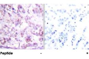 Immunohistochemical analysis of paraffin-embedded human breast carcinoma tissue using MYB polyclonal antibody . (MYB antibody  (Ser12))