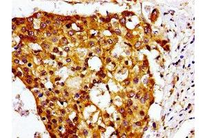 Immunohistochemistry of paraffin-embedded human breast cancer using ABIN7147549 at dilution of 1:100 (CMKLR1 antibody  (AA 321-373))