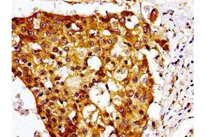Immunohistochemistry of paraffin-embedded human breast cancer using ABIN7147549 at dilution of 1:100 (CMKLR1 antibody  (AA 321-373))