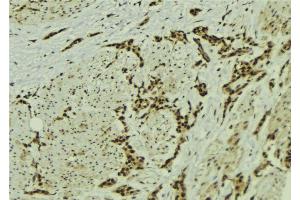 ABIN6273056 at 1/100 staining Human breast cancer tissue by IHC-P. (MMS19 antibody  (Internal Region))