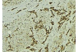 ABIN6273056 at 1/100 staining Human breast cancer tissue by IHC-P. (MMS19 antibody  (Internal Region))